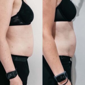 Kvinde har tabt 20 cm om mave med fedtfrysning maskine